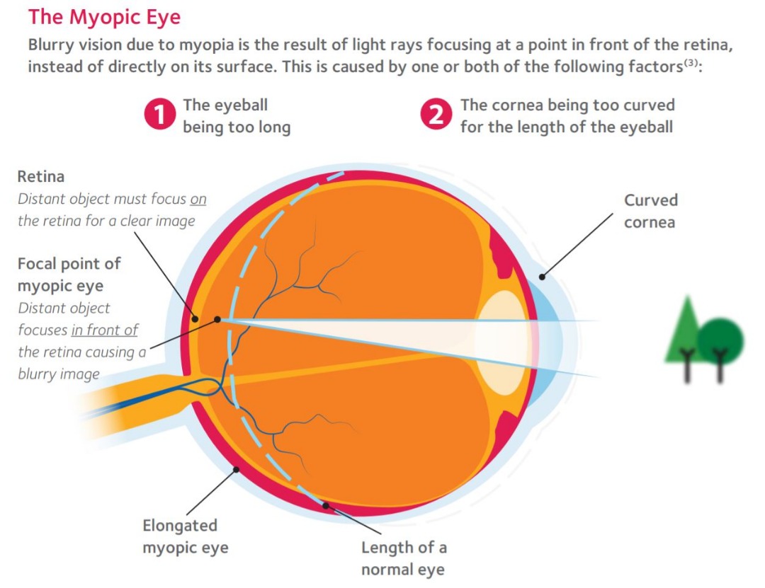 myopia-risk-check-mata-clinic-optometrist-blog