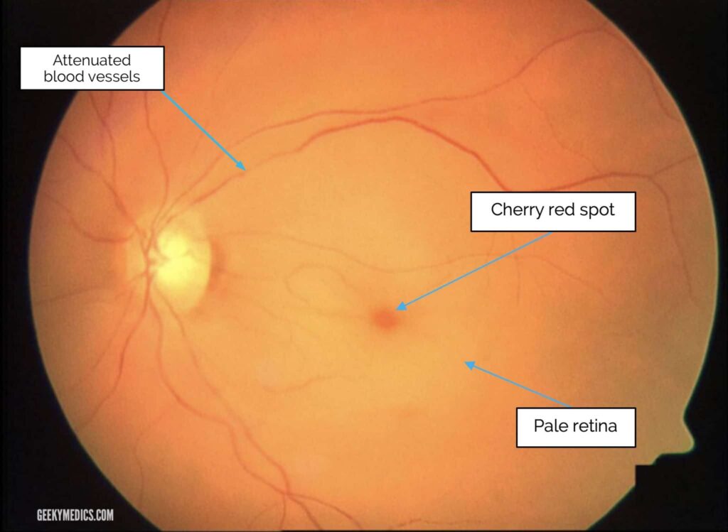 Patient Education Series: Central Retinal Artery Occlusion - Mata ...
